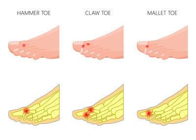 Claw Toe, Hammer Toe and Mallet Toe