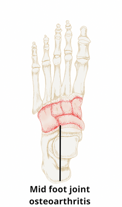Midfoot Arthritis