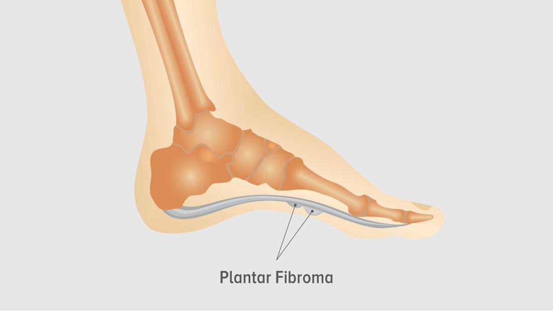 Shoe inserts for plantar on sale fibroma