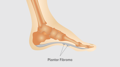 Plantar Fibroma