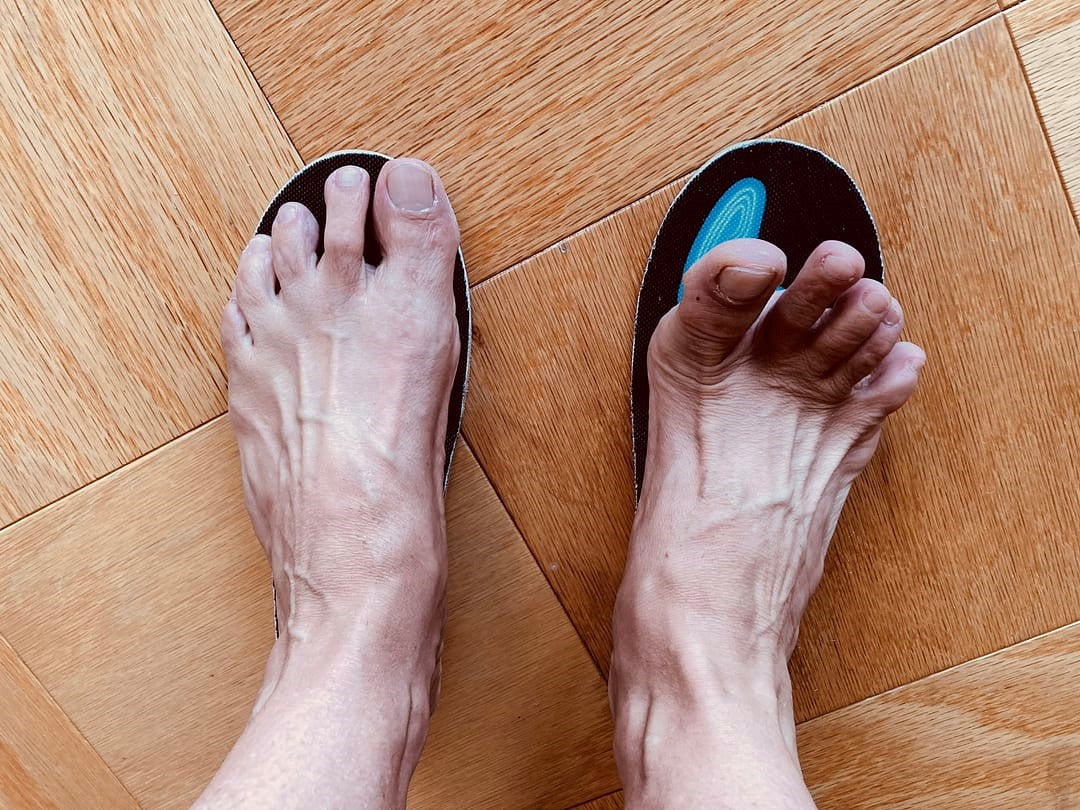 High Arches Don't Have to Hurt