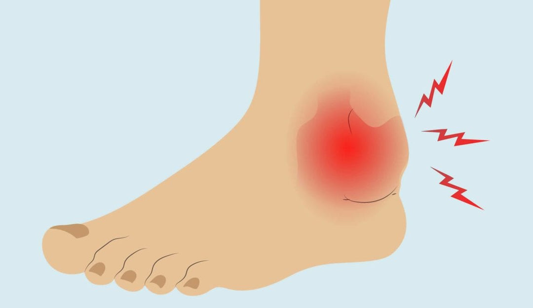 Ankle Arthritis