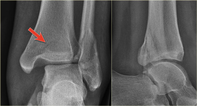 Ankle Fracture