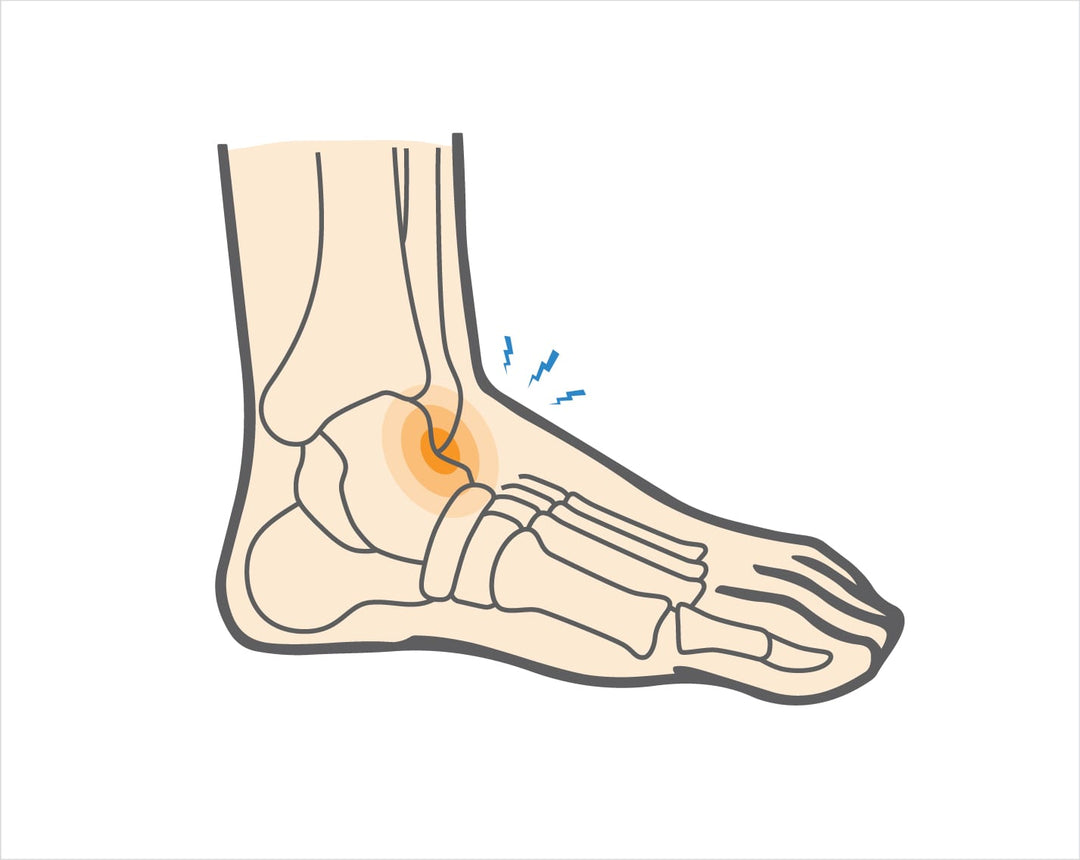 Ankle Impingement