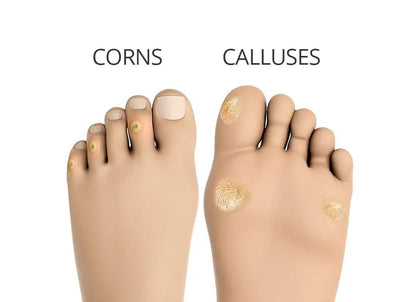 Corns and Calluses