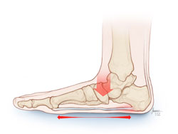 Flat Foot / Fallen Arch – Foot Scientific Store