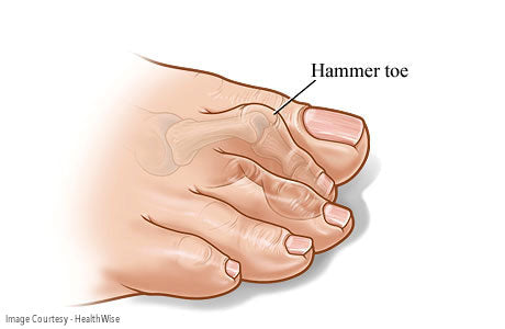 Hammer Toe