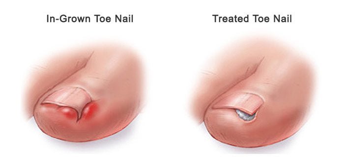 Ingrown Toenail