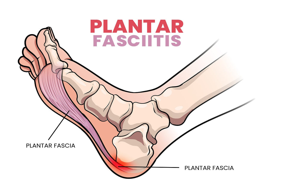 Understanding Plantar Fasciitis: Causes, Symptoms, and Treatment