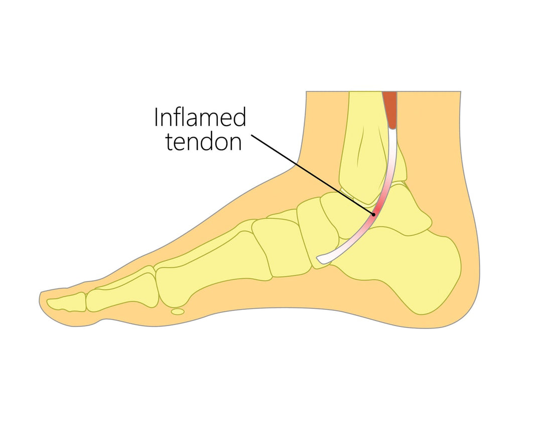 Posterior Tibial Tendonitis