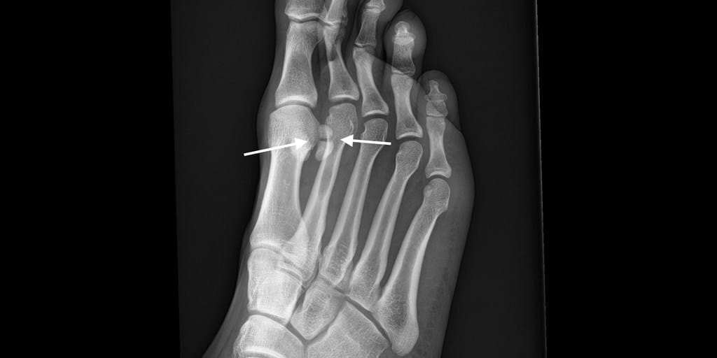 Sesamoiditis Fracture