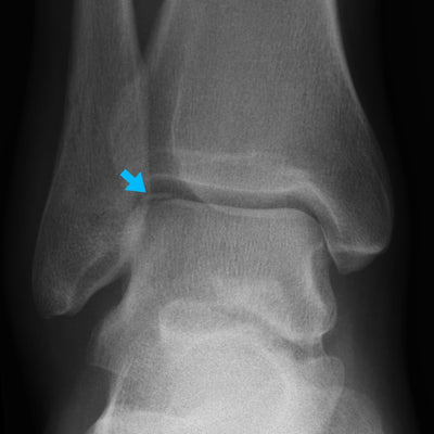 Talar Dome Fracture
