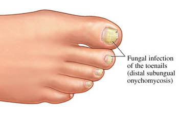 Toenail Fungus