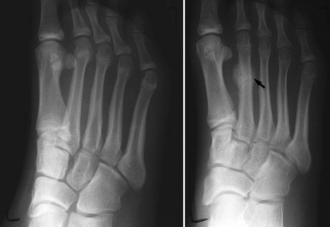 Stress Fracture